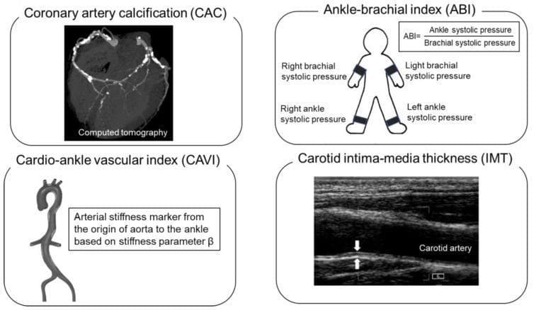 Educational infographic panel demonstrating four non-invasive modalities for atherosclerosis assessment and cardiovascular risk stratification. 1. Coronary Artery Calcification (CAC): A cross-sectional Computed Tomography (CT) scan of the heart showing hyperdense (bright) calcium deposits along the coronary arteries. 2. Ankle-Brachial Index (ABI): A schematic diagram of a human figure indicating systolic blood pressure measurement points at the brachial and ankle arteries, including the calculation formula (Ankle SP / Brachial SP) used to screen for peripheral artery disease. 3. Cardio-Ankle Vascular Index (CAVI): An anatomical diagram of the aorta and central arterial tree, labeled as an arterial stiffness marker derived from the stiffness parameter beta. 4. Carotid Intima-Media Thickness (IMT): A grayscale longitudinal ultrasound image of the carotid artery, with calipers/arrows highlighting the measurement of the vessel wall layers. This compilation serves as a clinical guide for evaluating subclinical atherosclerosis and predicting heart failure risk through diverse imaging and physiological markers.