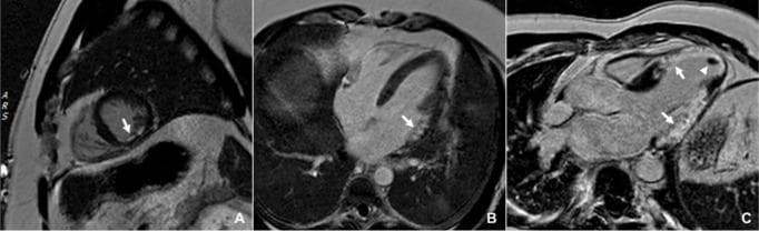 This diagnostic imaging composite displays three Cardiac Magnetic Resonance (CMR) images utilizing Phase-Sensitive Inversion Recovery (PSIR) Late Gadolinium Enhancement (LGE) to illustrate varying patterns of myocardial infarction (MI). Image A (mid-ventricular short-axis view) demonstrates a subendocardial infarction in the mid-inferior wall, characterized by hyperenhancement involving approximately 50% of the myocardial thickness. Image B (horizontal long-axis view) identifies a subendocardial infarction in the basal anterolateral wall with a deeper transmural extent of approximately 75%. Image C (left ventricular outflow tract view) reveals extensive pathology including two large transmural infarctions located at the anteroseptum/apex and the inferolateral wall. Additionally, an apical thrombus is identified in Image C, appearing as a dark, non-enhancing filling defect at the ventricular apex. These images serve as educational examples of how LGE imaging assesses tissue viability, infarct location, and the degree of transmurality, which are critical for prognostic stratification and identifying potential substrates for cardiac arrhythmias.