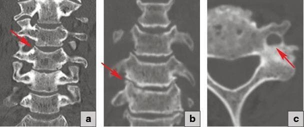 This composite diagnostic image consists of three panels demonstrating the progression of uncovertebral joint pathology in the cervical spine. (a) A coronal CT reconstruction showing a normal uncovertebral joint. The uncinate processes appear sharp and well-defined with a clear, uniform joint space (indicated by the red arrow). (b) A coronal CT reconstruction showing uncovertebral arthrosis. The red arrow highlights degenerative changes characterized by subchondral sclerosis and flattening of the uncinate process, resulting in joint space narrowing. (c) An axial CT scan showing hypertrophic uncovertebral arthrosis. The red arrow identifies significant bony overgrowth (osteophytosis) originating from the uncovertebral joint. This hypertrophic change causes encroachment and narrowing of the adjacent foramen transversarium, which clinically risks compression of the vertebral artery. These images serve as educational materials for neuroradiology and orthopedics, illustrating the spectrum from healthy anatomy to advanced degenerative joint disease and its secondary effects on adjacent vascular pathways.