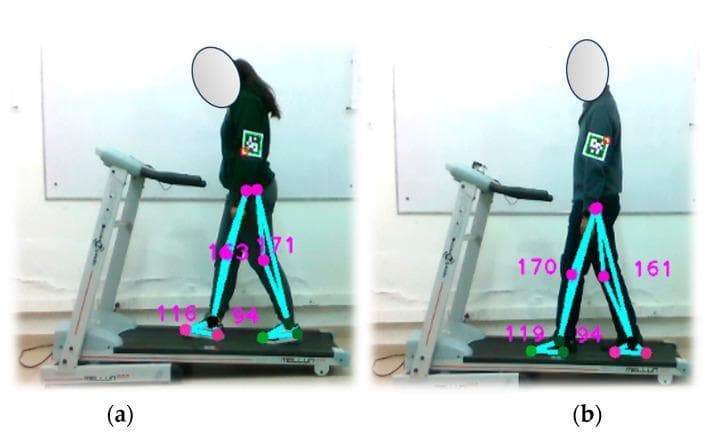 This composite image (labeled a and b) demonstrates an optical motion capture system used for gait analysis during a walking test on an electric treadmill. Two human subjects are shown in the sagittal plane, walking at a controlled speed of 1.5 km/h in an indoor laboratory environment. The visual illustrates markerless pose estimation and pedometer functionality. Overlaying the subjects' lower limbs are pink dots representing anatomical joint centers (hip, knee, ankle, and metatarsophalangeal joints) and light blue lines defining limb segments. Numerical values in magenta indicate joint angles or distances, facilitating the assessment of joint amplitude and gait cycle phases. ArUco markers are affixed to the upper arms for supplemental positional tracking. The setup is designed for the diagnostic assessment of gait-related conditions, utilizing a depth camera to monitor kinematic parameters like stride length, foot positioning, and limb synchronization. Factors such as attire contrast and lighting are critical for the accuracy of these biomechanical measurements.