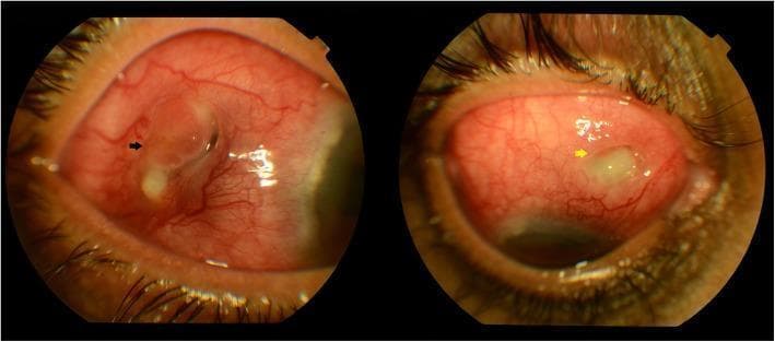 Clinical photograph of the anterior segment of the right eye demonstrating severe necrotizing scleritis. The image shows marked, diffuse episcleral and scleral vascular congestion (hyperemia). Two distinct areas of scleral melt are visible: one in the temporal quadrant indicated by a black arrow, and a second, newer focal area of melting in the superonasal quadrant indicated by a yellow arrow. The areas of melting appear as regions of significant scleral thinning and tissue loss, with irregular borders and associated yellowish-white necrotic debris. This clinical presentation is characteristic of advanced autoimmune-mediated or infectious scleritis, indicating a high risk of ocular perforation. The surrounding conjunctival tissue is intensely injected, reflecting an active, severe inflammatory process.