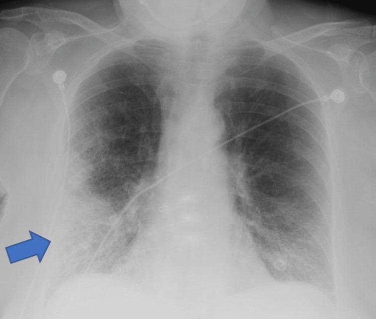 A frontal (anteroposterior) chest X-ray demonstrating clinical signs of pneumonia. A prominent blue arrow indicates a large area of increased opacity in the right lower lung field, suggestive of lobar consolidation or a dense pulmonary infiltrate. The opacity is heterogeneous with ill-defined borders, blending into the surrounding parenchyma. Beyond the focal area, there are diffuse bilateral reticulonodular interstitial markings, more pronounced in the mid and lower lung zones. The right costophrenic angle is relatively sharp, while the left shows mild blunting. Several medical devices are present: multiple radiopaque ECG leads/electrodes are positioned on the upper chest and shoulders, and a radiopaque enteric tube (nasogastric or feeding tube) is visible traversing the mediastinum toward the stomach. The image illustrates typical radiological findings of an infectious process in an acute clinical setting, highlighting focal consolidation against a background of generalized pulmonary congestion or inflammation.