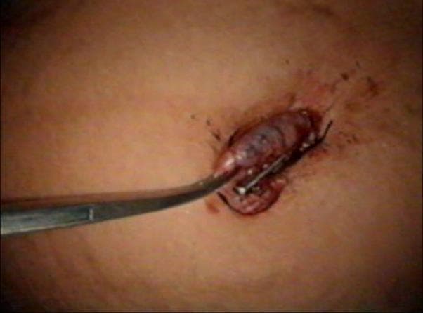 This clinical photograph captures a critical step in the extraction phase of a laparoscopic cholecystectomy. The image shows the gallbladder being retrieved through a 10 mm umbilical port incision. The gallbladder appears dark, reddish-purple, and distended, with visible surface striations suggesting inflammation or congestion. A long, metallic artery forceps is securely clamped onto the cystic duct end of the gallbladder at the level of the skin incision to facilitate its manual extraction. Adjacent to the forceps, a laparoscopic grasper is visible, having just been released from the gallbladder tissue and closed under direct vision. The surrounding skin at the umbilical site shows minor surgical trauma and blood consistent with the port-site retrieval process. This visual demonstrates the surgical technique of transitioning from laparoscopic manipulation to externalized mechanical traction for specimen removal, emphasizing port-site management and tissue handling in minimally invasive abdominal surgery.