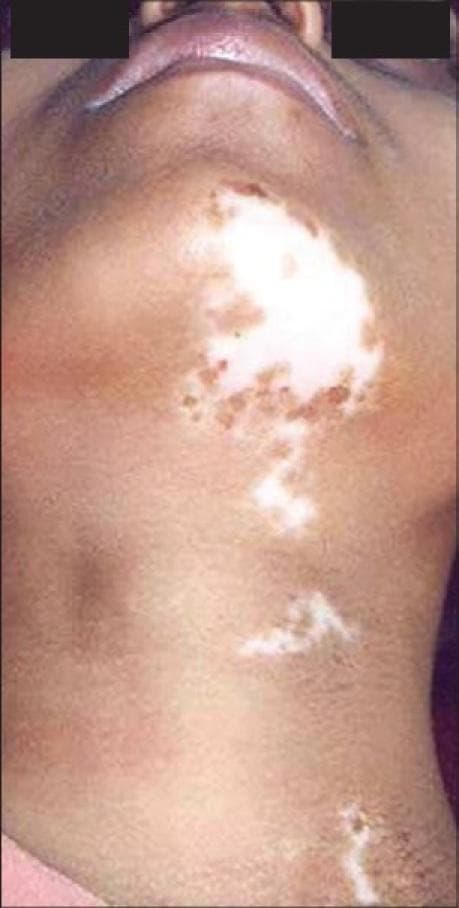 Clinical photograph of the anterior neck and submental region of a patient with medium-brown skin tone, demonstrating segmental vitiligo. The image shows several distinct, milky-white depigmented macules and patches. The largest patch is centrally located on the submental area and upper neck, characterized by irregular borders and follicular repigmentation (pigmented specks within the depigmented area). Smaller, satellite-like depigmented macules extend inferiorly along the midline of the neck in a linear or segmental distribution. There is a sharp contrast between the amelanotic (depigmented) areas and the surrounding normally pigmented skin. The photograph illustrates characteristic features used in dermatology to identify stable vitiligo and assess for signs of repigmentation following therapeutic interventions like PUVA or surgical grafting.