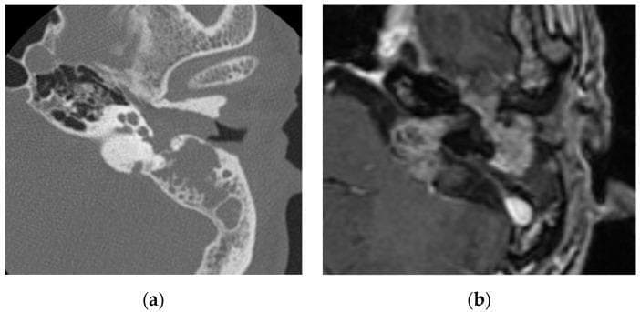 This composite diagnostic image illustrates a facial nerve schwannoma through two imaging modalities. Image (a) is an axial non-contrast computed tomography (CT) scan of the temporal bone, showing a soft-tissue density shadow occupying the external auditory canal, middle ear cavity, and mastoid region. Notably, there is evidence of expansile bone erosion and remodeling around the tympanic and mastoid segments. Image (b) presents a contrasted T1-weighted magnetic resonance image (MRI) of the same region. It reveals a robustly enhancing mass lesion extending along the anatomical course of the facial nerve, involving the cerebellopontine angle, internal auditory canal, and middle ear. The lesion exhibits a characteristic tubular or 'sausage-link' appearance typical of nerve sheath tumors. These visual findings demonstrate the primary features used for differentiating facial nerve schwannomas from other temporal bone masses like hemangiomas or glomus tumors, emphasizing the role of CT in assessing bone destruction and MRI contrast enhancement in delineating perineural tumor spread.