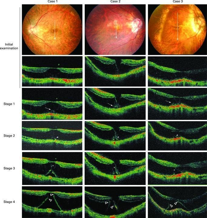 This diagnostic composite illustrates the longitudinal progression from myopic macular retinoschisis (MRS) to early retinal detachment (RD) across three patient cases. The top row features posterior fundus photographs showing myopic changes and tessellated fundi. Below, four rows of Optical Coherence Tomography (OCT) cross-sections track four evolutionary stages. Initial examinations show MRS with clear splitting of retinal layers. Stage 1 demonstrates focal thickening and irregularity of the external retinal layer (marked by arrows). Stage 2 reveals the development of an outer lamellar hole (arrowheads) beneath the thickened area. Stage 3 shows horizontal separation and bridging of the retinoschisis layer (asterisks) as the outer lamellar hole expands. Stage 4 depicts advanced RD with the resolution of retinoschisis, where remnants of the external retina (open arrowheads) remain attached to the inner retinal layers. This image serves as a clinical reference for monitoring high myopia complications and the specific morphological changes preceding full-thickness macular holes or total foveal detachment.