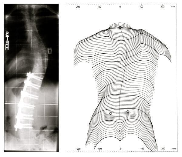 This composite educational graphic illustrates post-surgical lateral decompensation in Adolescent Idiopathic Scoliosis (AIS). On the left, a posterior-anterior (PA) diagnostic X-ray of the spine shows a lumbar curve stabilization using spinal fusion instrumentation, consisting of a longitudinal metal rod and multiple pedicle screws. Despite the lumbar fusion, a significant compensatory thoracic curve is visible, resulting in coronal imbalance. On the right, a corresponding posterior trunk surface topography diagram (line drawing) maps the external cosmetic deformity. The topographic lines demonstrate clear asymmetry: the right side of the upper torso is more prominent, while the left side of the lower torso projects further outward. This side-by-side comparison demonstrates the lack of correlation between internal radiographic correction of a single curve and the overall clinical/cosmetic balance of the trunk, highlighting the phenomenon where progression of an unfused curve leads to patient dissatisfaction due to persistent postural imbalance.