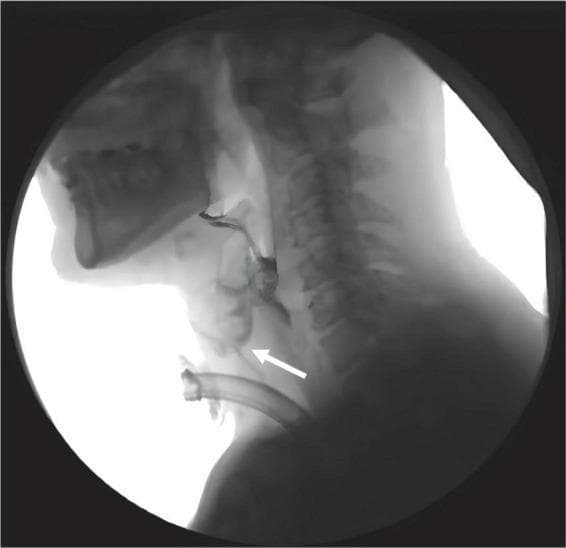 This diagnostic image is a lateral view from a Videofluoroscopic Swallowing Study (VFSS) captured using X-ray radiography. The anatomical focus includes the oral cavity, pharynx, larynx, and cervical spine. A radiopaque tracheostomy tube is visible in the lower neck region. A radiopaque contrast bolus (iohexol) is present in the oral cavity and pharyngeal space. A white arrow highlights a clear aspiration event, showing the contrast bolus deviating from the normal swallowing pathway and entering the laryngeal vestibule and upper airway above the level of the tracheostomy tube. This demonstrates a failure of the normal airway protection mechanisms during deglutition, resulting in aspiration. This clinical image is typical for assessing dysphagia and swallowing biomechanics in patients following acquired brain injury (ABI) to determine the Penetration-Aspiration Scale (PAS) score and the efficacy of interventions like the Passy Muir Valve (PMV).