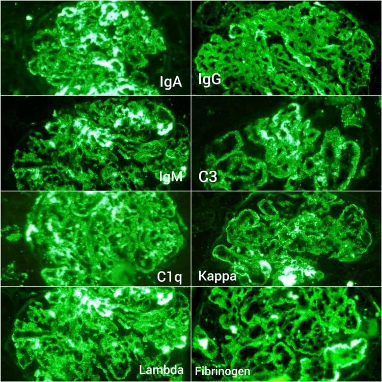 This composite diagnostic image displays eight panels of renal immunofluorescence microscopy at 200x magnification, illustrating a 'full house' staining pattern diagnostic of Lupus Nephritis (LN). The panels show granular deposits of IgA, IgG, IgM, C3, C1q, Kappa, and Lambda light chains within the glomerulus. The staining for these immunoglobulins and complement components is diffuse and granular, involving the mesangium and capillary loops. The final panel demonstrates fibrinogen immunostaining, which exhibits high-intensity (3+) positivity. Unlike the more uniform granular appearance of the immunoglobulins, the fibrinogen staining is specifically localized to glomerular capillary structures, indicating fibrin deposition consistent with intraglomerular thrombi and thrombotic microangiopathy (TMA). This visual evidence is critical for the classification of Class IV Lupus Nephritis and for assessing the activity index of the disease through the presence of necrosis and thrombosis.