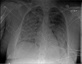 This diagnostic image is an anteroposterior (AP) chest X-ray demonstrating severe, diffuse bilateral pulmonary infiltrates. The infiltrates are characterized by extensive, fluffy, alveolar opacities distributed throughout both lung fields, consistent with Acute Respiratory Distress Syndrome (ARDS) or Transfusion-Related Acute Lung Injury (TRALI). Notable medical devices are visible, including an endotracheal tube (ETT) for mechanical ventilation and a central venous catheter, indicating a critically ill patient receiving advanced life support. Electrocardiogram (ECG) leads are also superimposed over the thorax. The cardiac silhouette appears within normal limits for size, which, combined with the diffuse pulmonary edema-like appearance, suggests a non-cardiogenic origin of the pulmonary infiltrates. This image serves as a clinical example of rapid-onset pulmonary complications following medical procedures, emphasizing the radiological presentation of acute lung injury in a critical care setting.
