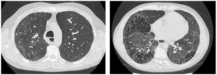 Two axial slices of high-resolution computed tomography (HRCT) of the chest demonstrating a classic Usual Interstitial Pneumonia (UIP) pattern. The images show significant bilateral lung parenchymal abnormalities with a subpleural and basal predominance. Key radiologic features include extensive honeycombing, characterized by clustered, thick-walled subpleural cystic airspaces, and prominent reticular opacities. Additionally, there is evidence of traction bronchiectasis, where the fibrotic destruction of the lung architecture has caused irregular dilation of the bronchi. These findings are consistent with end-stage pulmonary fibrosis, often seen in idiopathic pulmonary fibrosis or connective tissue disease-associated interstitial lung disease (such as systemic sclerosis). The images serve as an educational example of advanced architectural distortion and the characteristic distribution of UIP-pattern fibrosis, distinguishing it from other interstitial lung diseases by the presence of honeycombing and peripheral gradient.