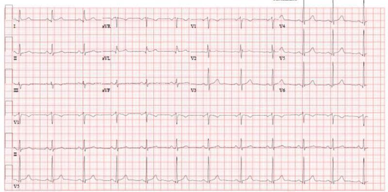This diagnostic image is a standard 12-lead electrocardiogram (ECG) displayed on a pink-and-white grid-calibrated background. The tracing represents a human heart at rest and demonstrates a normal sinus rhythm. All 12 leads are clearly labeled and organized into columns: the limb leads (I, II, III), augmented vector leads (aVR, aVL, aVF), and precordial leads (V1 through V6), with additional rhythm strips provided at the bottom (VI, II, V5). Each cardiac cycle displays a distinct P wave preceding every QRS complex, followed by a consistent T wave. The heart rate is regular, and the morphology of the waveformsโincluding the PR interval, QRS duration, and ST segmentsโappears within normal physiological limits, showing no signs of acute ischemia, hypertrophy, or conduction blocks. This visual is suitable for cardiology education to demonstrate baseline normal findings in a healthy cardiac patient.