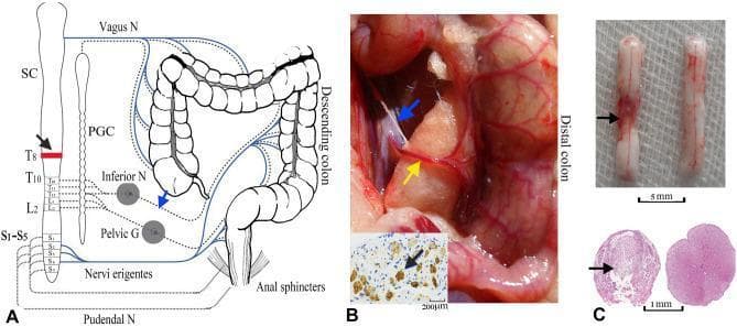 This composite educational graphic illustrates the neuroanatomical basis for peri-arterial sympathectomy of the inferior mesenteric artery (PSIMA) in a spinal cord injury (SCI) model. Panel A presents a human anatomical diagram showing the autonomic innervation of the colon; sympathetic outflow (T10-L2) is indicated by dashed lines via the paravertebral ganglia chain (PGC) and inferior mesenteric ganglia, while parasympathetic innervation (S2-S4) via the pelvic nerves is shown in blue. A black arrow indicates the T8 SCI level. Panel B provides an intraoperative photograph of a rat model, detailing the anatomical relationship between the distal colon, the inferior mesenteric artery (yellow arrow), and the accompanying sympathetic plexus (blue arrow). An inset shows TH-stained sympathetic nerve fibers. Panel C displays the pathological consequences of injury, comparing an SCI-damaged spinal cord segment (left, showing gross discoloration and narrowing) with a normal control (right). Lower histological images (HE staining) demonstrate complete loss of tissue architecture and cavitation in the transverse section of the injured cord compared to the intact control. This visual material is used to demonstrate surgical interventions for neurogenic bowel dysfunction.