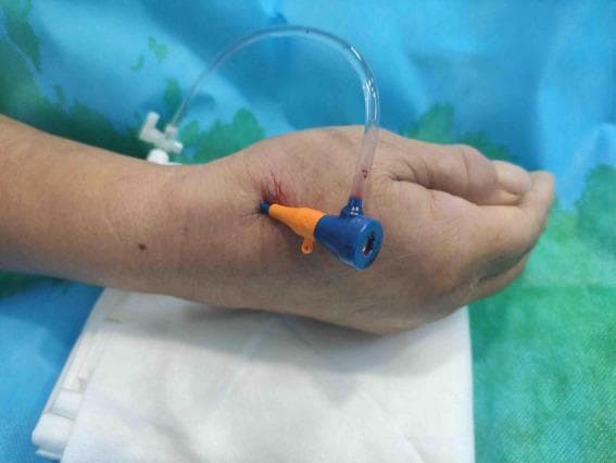 A clinical photograph depicting a 7F thin-walled arterial sheath inserted into the distal radial artery, specifically via the anatomical snuffbox of the hand. The patient's hand is resting in a palm-down or neutral position. The visible medical equipment includes a multi-colored (blue and orange) hub at the insertion site, featuring a central port for catheter access. A clear, flexible side-arm tube is connected to the hub, showing a trace amount of blood, which is typical during vascular access. The puncture site shows minor localized erythema and a small amount of dried blood, consistent with recent percutaneous insertion using the Seldinger technique. This visual demonstrates the distal transradial approach (dTRA), an alternative access point for coronary angiography and percutaneous coronary intervention (PCI) that aims to reduce the risk of proximal radial artery occlusion.