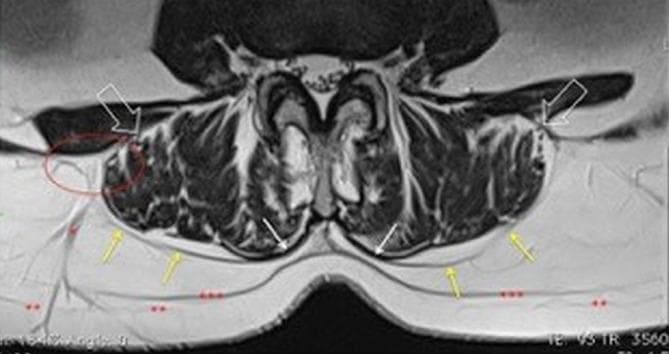 This diagnostic axial MRI scan demonstrates the detailed anatomy of the posterior lumbar musculature and fascial layers. The image highlights the Thoracolumbar Fascia (FTL) and its relationship to the erector spinae muscles. Yellow arrows indicate the posterior lamina of the FTL, while white open arrows denote the anterior lamina; these two layers are seen converging at the lateral raphe (red oval). The epimysium of the erector spinae is marked by white arrows, showing a distinctive fusion or lack of a fat plane where it becomes inseparable from the FTL near the spinous processes. Subcutaneous tissue organization is visible, with the superficial subcutaneous fascia marked by double asterisks (**) and the deep subcutaneous fascia marked by triple asterisks (***). A venous vessel is also seen traversing from the lateral raphe toward the skin. This educational image illustrates the compartmentalization of paraspinal muscles and the biomechanical integration between muscular epimysium and aponeurotic fasciae, relevant for understanding myofascial force transmission and low back pain pathologies.