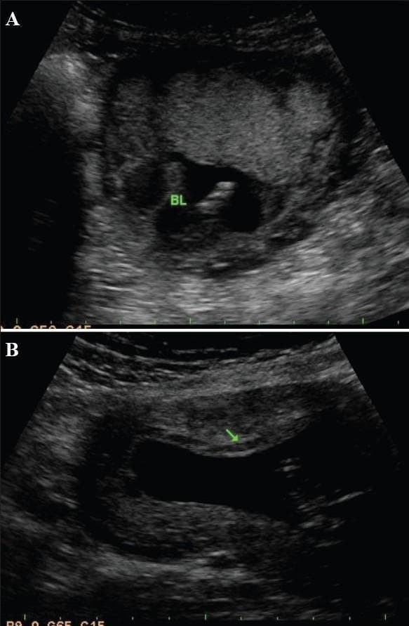 This diagnostic comparison image consists of two B-mode obstetric ultrasound frames (A and B) demonstrating subchorionic bleeds in different clinical presentations. In Image A, a localized, anechoic (black) fluid collection labeled 'BL' is visible at the fundal end of the placenta. Image B shows a more extensive anechoic region adjacent to the anterior placenta, indicated by a green arrow. In both cases, the placental tissue displays a characteristic heterogeneous, hyperechoic (brighter gray) texture relative to the bleeds. The anechoic nature of these fluid collections is clinically significant as it indicates chronic rather than acute hemorrhage, as resolving hematomas lose their internal echogenicity over time. These images serve as educational examples for identifying subchorionic hematomas, assessing their spatial relationship to the placental implantation site (fundal vs. anterior), and utilizing echogenicity to estimate the age of the hemorrhage during routine prenatal screening.