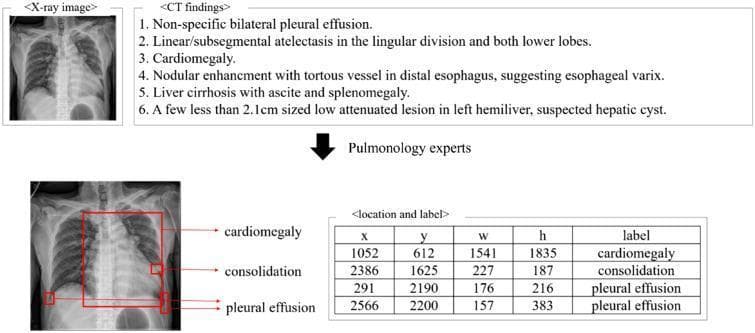 This infographic illustrates a data preprocessing workflow for medical imaging, specifically focusing on the annotation of chest X-rays (CXRs) using chest CT findings as a reference. The top of the diagram displays an initial X-ray image paired with a detailed list of CT findings, including pleural effusion, atelectasis, cardiomegaly, esophageal varix, liver cirrhosis, and hepatic cysts. A downward arrow points to the 'Pulmonology experts' stage, which transitions to the annotated output. The bottom section shows an annotated posterior-anterior (PA) chest X-ray with red bounding boxes identifying specific pathologies: cardiomegaly (central chest), consolidation (left lower lung zone), and bilateral pleural effusion (costophrenic angles). Accompanying the annotated image is a structured data table titled 'location and label,' which quantifies each bounding box using five attributes: x-coordinate, y-coordinate, width (w), height (h), and the diagnostic lesion class. This illustrates a ground-truth labeling process necessary for training machine learning models in thoracic radiology.