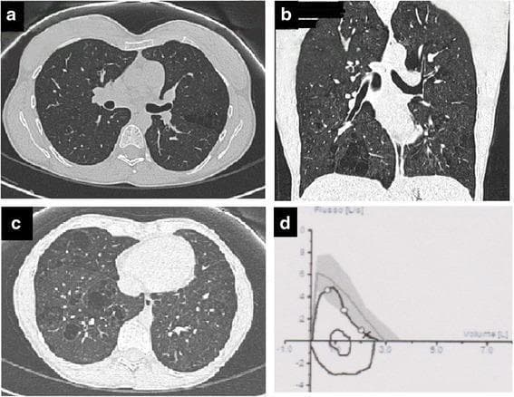 This composite educational graphic consists of High-Resolution Computed Tomography (HRCT) lung windows and a pulmonary function test graph. Panels a and c are axial HRCT slices, while panel b provides a coronal reconstruction. These images demonstrate atypical emphysematous changes characterized by thin-walled, bullous-like destructions. Notably, the emphysema exhibits a distribution pattern featuring a single layer of subpleural-like bubbles delineated by interlobular septa, but unusually located toward the lung center and predominantly affecting the lower lobes. These features are contrasted with typical centrilobular emphysema (upper lobe predominance) and paracicatricial emphysema (thick-walled cysts). Panel d displays a flow-volume loop from a spirometry assessment, plotting flow (L/s) against volume (L). The loop morphology and position within the shaded reference range indicate normal global lung function despite the visual radiological pathology. This case serves as a comparison chart for identifying atypical presentations of paraseptal emphysema in the clinical context of rare systemic conditions like Goltz syndrome.