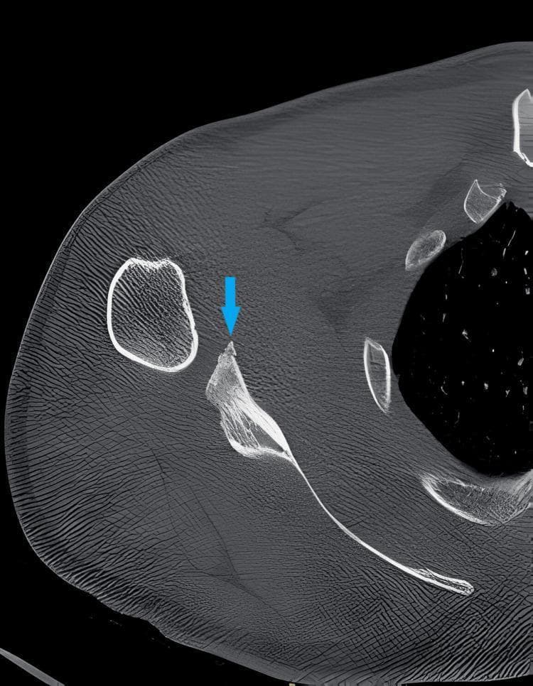 This diagnostic image is an axial Computed Tomography (CT) scan of a right shoulder, focused on the glenohumeral joint and scapula. The scan demonstrates a bony Bankart lesion, which is indicated by a blue arrow. Visually, the lesion manifests as a small, irregular avulsion fracture at the anterior-inferior aspect of the glenoid rim. The detached bony fragment is clearly visible adjacent to the primary margin of the glenoid fossa. This finding is a hallmark of anterior shoulder instability, often occurring during an anterior dislocation where the humeral head impacts and shears off a portion of the glenoid. In this axial view, the relationship between the fractured anterior rim and the main body of the scapula is evident, facilitating the assessment of glenoid bone loss—a critical factor in determining the appropriate surgical intervention, such as a Latarjet procedure or labral repair. The surrounding trabecular bone of the scapula appears intact, and the visualized soft tissue densities provide anatomical context for the shoulder's musculoskeletal architecture.