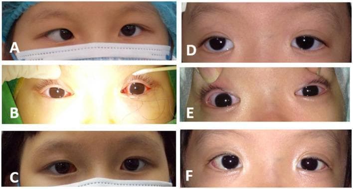A composite of six perioperative clinical photographs demonstrating the surgical correction of strabismus in two pediatric patients. The images are arranged in two columns (A-C and D-F) representing pre-operative, intra-operative, and one-week post-operative stages. Column A-C features a patient with esotropia (inward deviation of the eye); panel A shows the initial deviation, B shows the intra-operative adjustable suture technique with a corneal light reflex test, cotton swab, and visible sutures, and C shows successful orthophoric alignment (straight eyes). Column D-F features a patient with exotropia (outward deviation); panel D shows the pre-operative state, E captures the intra-operative adjustment phase showing conjunctival hyperemia and eyelid retraction, and F demonstrates postoperative orthophoria. The images illustrate the clinical application of a modified adjustable suture technique to achieve precise ocular alignment, emphasizing the use of the Hirschberg test (corneal light reflex) for intra-operative decision-making in ophthalmology.
