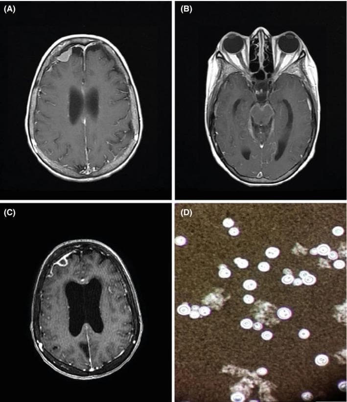 A multi-panel figure illustrating diagnostic findings for neurocryptococcosis. Panels A, B, and C are axial T1-weighted post-contrast brain MRI scans. Panel A shows a right frontal, extra-axial, pseudo-meningiomatous lesion with homogeneous contrast enhancement. Panel B demonstrates diffuse, linear meningeal enhancement consistent with meningitis. Panel C, a follow-up MRI, reveals the progression of the right frontal lesion into an annular (ring-enhancing) structure, accompanied by significant ventricular enlargement indicating secondary hydrocephalus. Panel D is a cerebrospinal fluid (CSF) microscopy image using an India ink preparation. It shows characteristic encapsulated yeasts, identified as Cryptococcus neoformans, which appear as round, budding cells surrounded by a distinct clear halo (the capsule) that excludes the dark ink particles in the background. This composite image serves as an educational resource for identifying the neuroimaging manifestations and laboratory diagnosis of fungal central nervous system infections.