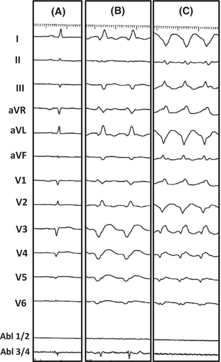This diagnostic image consists of three vertical panels (A, B, and C) displaying 12-lead electrocardiogram (ECG) tracings alongside intracardiac ablation catheter signals (Abl 1/2, Abl 3/4). Panel A represents the patient's baseline ECG, showing narrow QRS complexes and normal sinus rhythm. Panel B illustrates Ventricular Tachycardia (VT) Morphology 1, characterized by a wide-complex tachycardia with a right bundle branch block (RBBB) morphology in V1 and a predominantly positive axis in lead I. Panel C displays VT Morphology 2, which shows a different wide-complex tachycardia pattern with a more discordant QRS morphology across the precordial leads and higher frequency compared to Panel B. The image serves as an educational tool for comparing baseline cardiac rhythms with different morphologies of monomorphic ventricular tachycardia in the context of electrophysiology studies and catheter ablation. It demonstrates clinical features such as QRS widening, secondary ST-T wave changes, and morphology shifts indicative of different ventricular exit sites during a VT storm.