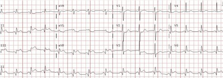 This diagnostic image is a standard 12-lead electrocardiogram (ECG) demonstrating an acute inferior ST-elevation myocardial infarction (STEMI). The tracing exhibits significant ST-segment elevation in the inferior leads (II, III, and aVF), accompanied by hyperacute T-wave morphology in these same leads. Reciprocal ST-segment depression is clearly visible in the anterior leads, specifically V2 and V3, with associated T-wave inversion. The QRS complexes are narrow and suggest a supraventricular rhythm, while the overall axis appears normal with upright complexes in leads I and aVF. Lead I also shows mild ST-segment depression. This ECG is a classic representation of acute myocardial injury involving the inferior wall of the heart, highlighting the importance of recognizing ST-segment elevation and reciprocal changes for rapid clinical diagnosis and intervention in cardiology and emergency medicine.