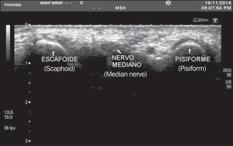 This diagnostic image is a transverse musculoskeletal (MSK) ultrasound of the right wrist at the level of the carpal tunnel inlet. The image captures the median nerve (labeled 'Nervo Mediano') positioned centrally between two bony landmarks: the scaphoid (labeled 'Escafoide') on the radial side and the pisiform (labeled 'Pisiforme') on the ulnar side. The bones appear as hyperechoic, curved surfaces with posterior acoustic shadowing. The median nerve is visualized as an oval, relatively hypoechoic structure with a speckled internal texture, characteristic of a honeycomb appearance formed by nerve fascicles. This imaging modality and view are clinically standard for evaluating the median nerve cross-sectional area (MNA) to diagnose Carpal Tunnel Syndrome (CTS). The anatomical relationship between the nerve and the bony floor of the carpal tunnel is clearly demonstrated for medical educational purposes regarding wrist anatomy and diagnostic sonography.