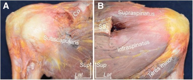 This clinical photograph displays a human cadaveric specimen dissection of a right shoulder, focusing on the rotator cuff musculature and their humeral insertions. The content is presented in two panels: (A) Anterior aspect and (B) Posterior aspect. In panel A, the subscapularis muscle is clearly labeled, demonstrating its broad muscle belly and fibers converging toward the lesser tuberosity of the humerus. The coracoid process (CP) is visible superiorly. In panel B, the posterior rotator cuff muscles are identified in relation to the scapular spine (SS). The supraspinatus is positioned superior to the spine, while the infraspinatus and teres minor are situated inferiorly, showing their tendinous progression toward the greater tuberosity. Spatial orientation is provided by superior (Sup) and lateral (Lat) directional indicators. The specimen has undergone resection of the acromion to provide an unobstructed view of the tendon footprints. This visual resource is intended for medical education regarding shoulder anatomy, surgical landmarks, and musculoskeletal pathology.