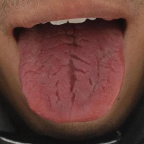 This clinical photograph shows a close-up, dorsal view of a human tongue, illustrating the condition known as fissured tongue (lingua fissurata). The tongue is pinkish-red and exhibits a distinct morphological pattern characterized by numerous grooves and deep fissures across its surface. A prominent central longitudinal groove runs along the midline from the posterior region toward the tip. Branching out laterally from this main fissure is a complex, asymmetric network of secondary cracks varying in depth and width. These fissures give the tongue a characteristic cracked or 'scrotal' appearance. The surrounding oral mucosa appears healthy, and there are no obvious signs of inflammation, ulceration, or abnormal coating in the visible area. In medical education and Traditional Chinese Medicine (TCM) diagnostics, such features are often indexed for tongue image analysis and machine learning applications to quantify crack visibility (FCI) and depth (FDI) indices for disease correlation.