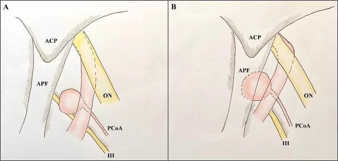 Anatomical comparison diagrams depicting the spatial relationships of the internal carotid artery (ICA) and posterior communicating artery (PCoA) aneurysms from an axial-oblique perspective. Diagram A illustrates a 'regular' PCoA aneurysm, where the aneurysmal neck is positioned at or above the level of the anterior clinoid process (ACP). The ICA shows minimal tortuosity, and the aneurysm is largely visible, lateral to the anterior perforated fossa (APF). Diagram B illustrates a 'low-lying' PCoA aneurysm, characterized by a neck located inferior to the ACP. In this variant, a significant portion of the aneurysm is obscured or 'covered' by the APF (indicated by dashed lines), and there is increased tortuosity between the ophthalmic and communicating segments of the ICA. Key neurovascular structures labeled in both diagrams include the ophthalmic nerve (ON), the oculomotor nerve (III), the ACP, the APF, and the PCoA originating from the ICA. These illustrations demonstrate the surgical anatomy relevant for neurosurgical clipping and the impact of vascular tortuosity on aneurysm location.