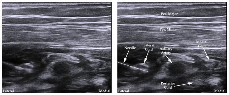 Side-by-side ultrasound images demonstrating the infraclavicular approach to a brachial plexus nerve block. The left image shows the raw sonogram, while the right image includes labels for anatomical structures and the needle. Superficially, the pectoralis major and pectoralis minor muscles are visible as horizontal, moderately echogenic striated layers. Deep to the pectoralis minor, the axillary artery appears as a central, hypoechoic circular structure. Surrounding the artery are the three cords of the brachial plexus: the lateral cord (lateral/superior to the artery), the medial cord (medial to the artery), and the posterior cord (posterior/deep to the artery). A hyperechoic linear structure representing a block needle is shown entering from the lateral aspect, oriented toward the nerve cords. This educational image illustrates the typical 'three-leaf clover' arrangement of the cords around the axillary artery used for regional anesthesia guidance in medical training.