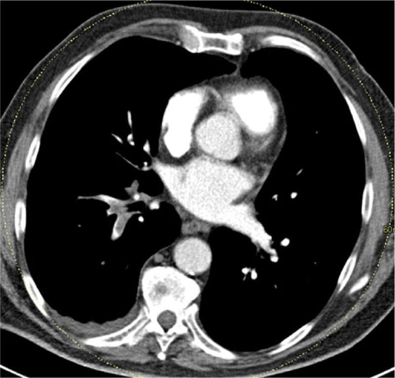 This diagnostic image is an axial contrast-enhanced CT Pulmonary Angiography (CTPA) of the thorax at the level of the main pulmonary artery bifurcation. The primary finding is the presence of multiple hypoattenuating intraluminal filling defects within the right pulmonary artery branches, characteristic of acute pulmonary embolism (PE). These defects represent thromboemboli partially or completely obstructing the vascular lumen. The mediastinal window demonstrates a patent ascending aorta, descending aorta, and superior vena cava with normal contrast opacification. The cardiac chambers visible at this level appear unremarkable in size. In the right posterior hemithorax, there is evidence of a small pleural effusion and adjacent dependent atelectasis or subpleural consolidation, which may correlate with pulmonary infarction in the clinical context of PE. The image serves as a classic educational example of utilizing CTPA for the definitive diagnosis of pulmonary thromboembolic disease by identifying pathognomonic filling defects in the pulmonary vasculature.