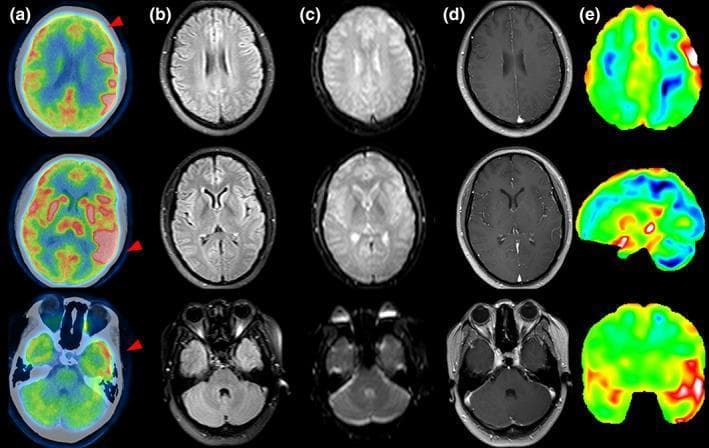 This diagnostic multi-modal imaging set displays axial brain slices from a patient with autoimmune encephalitis and an associated ovarian teratoma. The figure is organized into five columns: (a) FDG-PET, (b) T2-FLAIR MRI, (c) Diffusion-Weighted Imaging (DWI), (d) T1 contrast-enhanced MRI, and (e) FDG statistical deviation (z-score) maps. The FDG-PET images (column a) demonstrate significant metabolic abnormalities, specifically hypometabolism in the left middle frontal lobe (top row, blue/green regions) and prominent hypermetabolism in the bilateral basal ganglia and left temporal lobe (middle row, red/yellow hot spots). In contrast, the corresponding MRI sequences (columns b, c, d) appear unremarkable, showing no significant signal alterations on T2-FLAIR, no restricted diffusion on DWI, and no pathological gadolinium enhancement. The statistical deviation maps (column e) reinforce the PET findings by highlighting regions of metabolic asymmetry and deviation from the norm. This comparison illustrates a common clinical scenario where functional metabolic changes detected by PET precede visible structural abnormalities on conventional MRI in early-stage encephalitis.