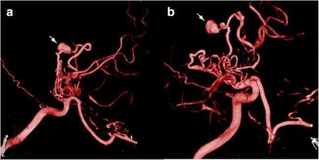 This diagnostic image shows a 3D reconstructed CT angiogram (CTA) of the cerebral vasculature in two views (a and b), highlighting a complex vascular network characteristic of Moyamoya disease (MMD). The reconstruction demonstrates significant stenosis of the distal internal carotid artery (ICA) and proximal segments of the anterior and middle cerebral arteries (ACA/MCA). A prominent, dense network of tortuous, 'puff-of-smoke' collateral vessels is visible in the basal regions, compensating for the occlusive disease. A distinctive white arrow in both views points to a large, saccular aneurysm (approximately 7mm) originating from a fragile collateral vessel near the terminal branches of the ACA. The aneurysm exhibits a wide neck and irregular morphology, appearing as a significant outpouching compared to the slender parent vessel. The images illustrate the increased hemodynamic stress placed on collateral pathways in MMD, leading to the formation and rapid growth of secondary aneurysms, which pose a high risk for intracerebral hemorrhage.