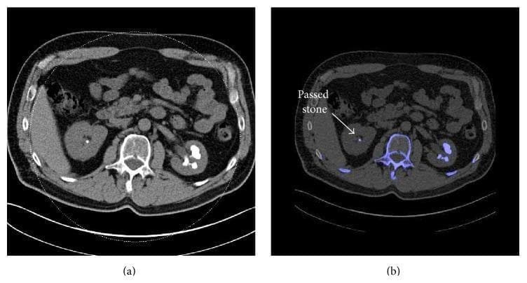 This figure presents a side-by-side comparison of axial abdominal imaging for nephrolithiasis. Image (a) is a conventional non-contrast Computed Tomography (CT) scan showing bilateral renal calculi. The left kidney contains a large, hyperdense staghorn calculus filling the renal pelvis and calyces, while the right kidney shows a smaller, discrete hyperdense stone. Image (b) shows a Dual-Energy CT (DECT) scan with post-processing for stone characterization. In the DECT image, the calculi are color-coded in blue, indicating they are non-uric acid (non-UA) stones (e.g., calcium oxalate, calcium phosphate, or cystine). A white arrow in image (b) highlights a small calculus in the right kidney labeled as a 'passed stone.' The DECT algorithm also applies blue color-coding to other high-density non-uric acid structures, such as the vertebral body. This comparison demonstrates the utility of DECT in distinguishing stone composition based on dual-energy ratios and three-material decomposition, which is critical for determining appropriate clinical management (medical dissolution versus urological intervention).
