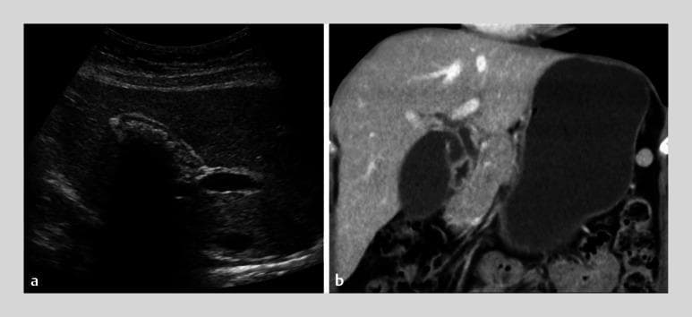A side-by-side comparison of diagnostic imaging modalities for cholelithiasis. Panel (a) is a transabdominal ultrasonography of the right upper quadrant. It reveals multiple hyperechoic, irregular structures within the gallbladder lumen. These structures exhibit classic posterior acoustic shadowing, where ultrasound waves are reflected or absorbed, resulting in a dark, anechoic void distal to the stones. Panel (b) is a contrast-enhanced computed tomography (CT) scan in the axial or coronal plane of the same patient. The CT shows the gallbladder as a well-defined, hypoattenuating, fluid-filled structure located adjacent to the liver. In contrast to the ultrasound, the CT scan demonstrates no high-density (calcified) structures within the gallbladder lumen, illustrating the higher sensitivity of ultrasonography for detecting certain types of biliary stones compared to standard CT. The image serves as an educational comparison of imaging sensitivity in gastroenterology and radiology.