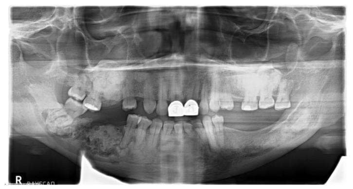 A panoramic dental radiograph (orthopantomogram) demonstrating extensive, multifocal pathology across all four quadrants of the jaws, characteristic of Florid Cemento-Osseous Dysplasia (FLCOD). The image shows a disorganized bone architecture with a classic mixed radiolucent-radiopaque appearance. Dense, sclerotic, cotton-wool-like radiopaque masses are predominantly located in the periapical regions of the mandible and maxilla. These lesions are often bordered by thin radiolucent rims. In the right posterior mandible, a particularly large, mottled, and dense calcified mass is visible. The patient exhibits several missing teeth, dental restorations (including radio-dense crowns on the maxillary central incisors), and impacted or displaced molars. There is evidence of significant alveolar bone remodeling and potential periapical involvement secondary to the dysplastic process. This diagnostic image serves as a clinical example of a benign fibro-osseous lesion commonly observed in middle-aged women of African descent.