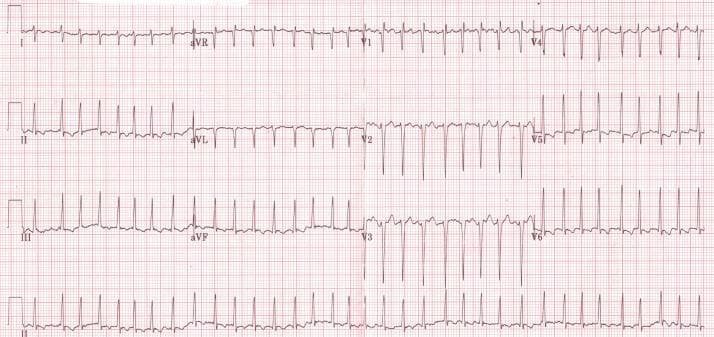 This diagnostic image is a standard 12-lead electrocardiogram (ECG) displayed on a red grid background. The tracing demonstrates a tachyarrhythmia characterized by a rapid ventricular response rate of approximately 160-165 beats per minute. Key diagnostic features include the absence of discernible P waves and an 'irregularly irregular' R-R interval, hallmark findings of atrial fibrillation. The QRS complexes are narrow (short duration), suggesting a supraventricular origin of the rhythm. Leads V1 through V3 show prominent S waves, while leads V5 and V6 demonstrate tall R waves, representing normal precordial progression but with high voltage. Minimal ST-segment fluctuations and T-wave abnormalities are present, likely secondary to the rapid rate. This ECG illustrates a common cardiac manifestation of severe thyrotoxicosis (hyperthyroidism), where high metabolic states trigger atrial fibrillation and sinus tachycardia. It serves as a classic educational example of tachyarrhythmia management in the context of endocrine emergencies.
