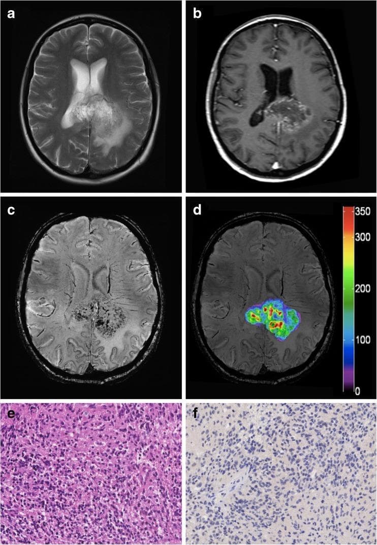 This composite figure illustrates a diagnostic workup of a high-grade glioma (HGG), specifically a glioblastoma (WHO grade IV) with negative IDH1-R132H mutational status. (A) Axial T2-weighted MRI displays a heterogeneous hyperintense lesion located in the posterior corpus callosum with surrounding vasogenic edema. (B) Contrast-enhanced T1-weighted MRI reveals significant ring-like enhancement, indicating blood-brain barrier disruption. (C) High-resolution 7 Tesla Susceptibility Weighted Imaging (SWI) shows numerous intratumoral hypointense foci, representing pathological microvasculature and microhemorrhages. (D) A Local Image Variance (LIV) map overlaid on the SWI correlates high variability (indicated by warm colors) with dense vascularity, providing a quantitative metric for tumor grading. (E) Histopathological H&E stain (200x) demonstrates hypercellularity, pleomorphism, and characteristics of a malignant glioma. (F) Immunohistochemistry (200x) confirms the negative IDH1-R132H mutational status. This multimodal comparison teaches the integration of advanced 7T imaging techniques with conventional radiology and pathology for precise brain tumor characterization.