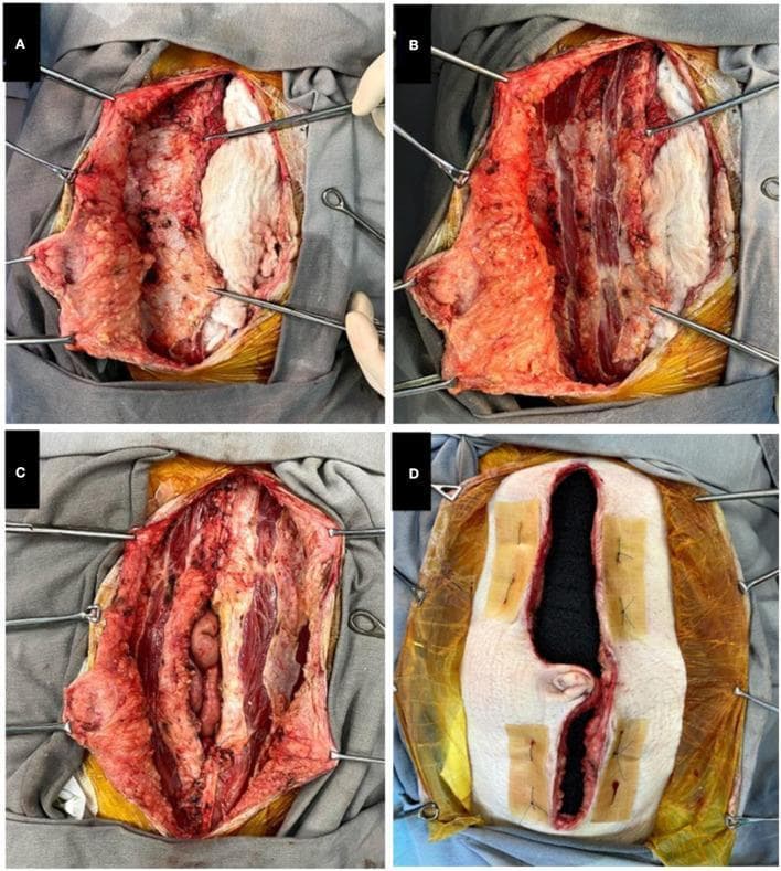 A series of four intraoperative clinical photographs (Panels A–D) documenting a surgical technique for abdominal wall closure, likely following intestinal transplantation. Panel A illustrates the initial 'components separation' technique, where the skin and subcutaneous fat are dissected away from the underlying musculature. Panel B shows 'relaxation incisions' made in the anterior sheath of the rectus abdominis muscle to increase fascia mobility. Panel C demonstrates the progressive approximation of the midline aponeurotic and skin edges using non-absorbable sutures, reducing the central defect. Panel D displays the application of a vacuum-assisted closure (VAC) system; black polyurethane foam is placed in the remaining wound defect, and the surrounding skin is protected by hydrocolloid plaques. Tension-relieving 'U' stitches are visible, along with clear adhesive drapes used to maintain a negative pressure seal. This sequence teaches a staged approach to complex abdominal wall reconstruction, emphasizing the management of large defects and the integration of negative pressure wound therapy (NPWT).