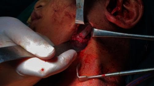 An intraoperative clinical photograph showing a surgical procedure for temporomandibular joint (TMJ) reconstruction, specifically focusing on costochondral grafting following ankylosis release. The surgical field is centered on the left preauricular and submandibular region of a pediatric patient. Several metal retractors, including a Dunn-Dautrey retractor, are utilized to provide exposure of the mandibular ramus. A harvested rib graft is visible, positioned against the lateral aspect of the ramus. The graft is undergoing rigid fixation; at least one bicortical screw is clearly visible securing the bone graft to the underlying mandibular bone. The surrounding soft tissues show active dissection and expected surgical bleeding. This image demonstrates the clinical application of autogenous bone grafting in maxillofacial surgery for restoring joint function and ramus height.