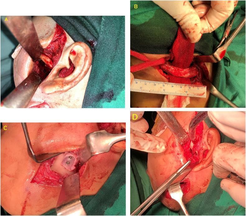 This set of four clinical photographs (A-D) documents the surgical management of temporomandibular joint (TMJ) reankylosis using interpositional arthroplasty and ramus-condyle unit reconstruction. Panel A shows the preauricular approach where a 20 mm gap has been surgically created between the glenoid fossa and the mandibular ramus. Panel B illustrates the harvesting of a costochondral graft from the 6th rib, with a surgical ruler indicating the graft's dimensions. Panel C demonstrates the fixation of the costochondral graft to the lateral aspect of the mandibular ramus using two osteosynthesis screws; the cartilaginous cap is oriented superiorly to serve as the new condylar head. Panel D shows the final stage of the procedure, involving the rotation and suturing of a temporalis fascia flap into the joint space to act as an interpositional barrier, preventing bone-to-bone contact and reducing the risk of recurrence. This sequence highlights key principles in oral and maxillofacial surgery for restoring joint mobility through autogenous grafting and soft tissue interposition.