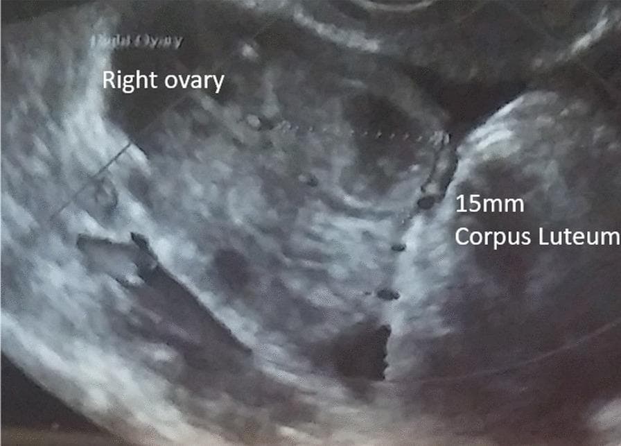 This diagnostic image is a transvaginal ultrasound of the right ovary, demonstrating post-ovulatory changes consistent with follicle rupture. The central finding is a 15mm corpus luteum, which appears as a hypoechoic (darker) cystic structure with irregular, somewhat thick walls and internal echoes, located within the heterogeneous ovarian stroma. The surrounding ovarian tissue exhibits a characteristic grainy echotexture. This imaging modality is used in reproductive medicine and gynecology for follicle tracking during ovulation induction or IVF/ICSI cycles. The visual transition from a clear, fluid-filled mature follicle to this collapsed, irregularly shaped corpus luteum confirms that ovulation has occurred. The image is annotated with labels identifying the 'Right ovary' and the '15mm Corpus Luteum,' making it an essential educational resource for understanding sonographic signs of the menstrual cycle's luteal phase.