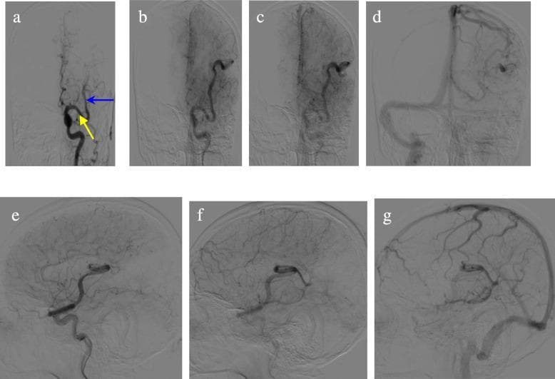 Digital subtraction angiography (DSA) of a left common carotid artery injection, displaying anteroposterior (AP, a–d) and lateral (e–g) views across multiple vascular phases. The imaging demonstrates a significantly enlarged and tortuous left middle cerebral artery (MCA). Key anatomical findings include multiple lateral striate arteries originating from the proximal M1 segment, a small vessel arising from the distal M1 segment (yellow arrow), and an additional branch originating from the proximal M2 segment (blue arrow). Hemodynamic characteristics show persistent visualization of the large MCA through the capillary phase (b, e), venous phase (c, f), and sinus phase (d, g), indicating delayed transit or slow outflow. Crucially, there is an absence of early venous drainage during the late arterial and capillary phases, which helps differentiate this arterial variation from high-flow arteriovenous shunts such as arteriovenous malformations (AVMs) or fistulas (AVFs).
