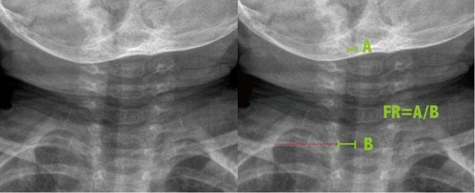 Antero-posterior (AP) soft tissue neck radiograph of a pediatric patient, presented as side-by-side images (unannotated and annotated) to demonstrate the methodology for calculating the Frontal Ratio (FR) of tracheal narrowing. The radiograph displays the cervical spine, base of the skull, clavicles, and the air-filled tracheal column. The annotated image on the right illustrates the measurement technique for subglottic stenosis: label 'A' marks the narrowest diameter of the subglottic trachea, while label 'B' indicates the reference tracheal width measured at the level of the clavicles. The mathematical relationship is provided as FR = A/B. This diagnostic imaging technique is typically used in the evaluation of upper airway obstruction, such as croup (laryngotracheobronchitis), where the 'steeple sign'—the characteristic tapering of the subglottic airway—is a hallmark finding. This material is designed for radiology and pediatric educational purposes to quantify the degree of airway constriction.