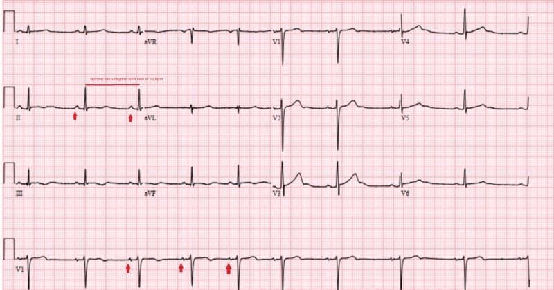 A standard 12-lead electrocardiogram (ECG/EKG) displayed on a pink grid, showing a normal sinus rhythm with a heart rate of approximately 57 beats per minute (bpm). The tracing includes the standard limb leads (I, II, III), augmented limb leads (aVR, aVL, aVF), and precordial leads (V1-V6). Red arrows in leads II and VI highlight clear P waves preceding each QRS complex, indicating sinus origin. The rhythm is regular with consistent R-R intervals and narrow QRS complexes. Precordial leads V1-V6 demonstrate normal R-wave progression, transitioning from a predominantly negative (S-wave dominant) morphology in V1 and V2 to a positive (R-wave dominant) morphology in V4 through V6. This tracing represents the resolution of cardiac arrhythmias (previously junctional bradycardia and A-V dissociation) following the correction of severe hypophosphatemia. The educational focus is on identifying normal sinus rhythm characteristics, including wave morphology and regular intervals in a clinical cardiology context.
