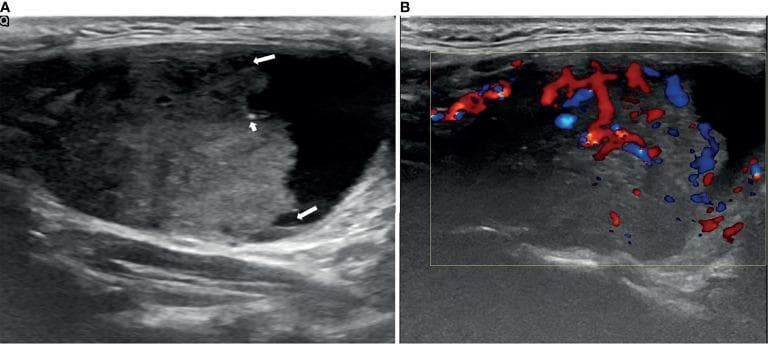 Diagnostic ultrasound of a thyroid nodule, presenting two side-by-side views. Panel (A) shows a longitudinal B-mode ultrasound of a 5.06 x 3.07 cm partially cystic thyroid nodule (PCTN). The nodule features a predominant hypoechoic solid component (occupying approximately 64% of the volume) situated eccentrically with an acute angle relative to the cyst wall. Arrows highlight an ill-defined margin and scattered punctate echogenic foci consistent with micro-calcifications. Panel (B) demonstrates a Color Doppler Flow Imaging (CDFI) study of the same nodule, revealing prominent internal and peripheral vascularity localized within the solid component. These sonographic features (eccentric solid component, ill-defined margins, micro-calcifications, and high vascularity) are clinically significant as they are highly suspicious for malignancy. This case was pathologically confirmed as papillary thyroid carcinoma. The image is intended for educational use in endocrinology and radiology to illustrate the ultrasound characteristics used in thyroid nodule risk stratification and scoring systems.