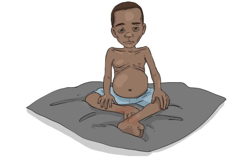 This medical illustration depicts a pediatric patient presenting with severe protein-energy malnutrition (PEM), specifically demonstrating clinical features associated with kwashiorkor or marasmic-kwashiorkor. The child is shown in a seated, cross-legged position. Key visual diagnostic signs include a protuberant, distended abdomen (ascites/hepatomegaly), marked muscle wasting in the upper and lower extremities, and a relative lack of subcutaneous fat, making the rib cage and clavicles visibly prominent. The facial features exhibit a gaunt appearance with sunken eyes and a flat, subdued affect, characteristic of the 'apathetic' demeanor often seen in severely malnourished children. The image serves as an educational tool for identifying the physical manifestations of chronic nutritional deficiency in global health settings, particularly emphasizing the paradox of a bloated abdomen despite generalized emaciation. This illustration is designed for healthcare worker training in malnutrition assessment and triage.