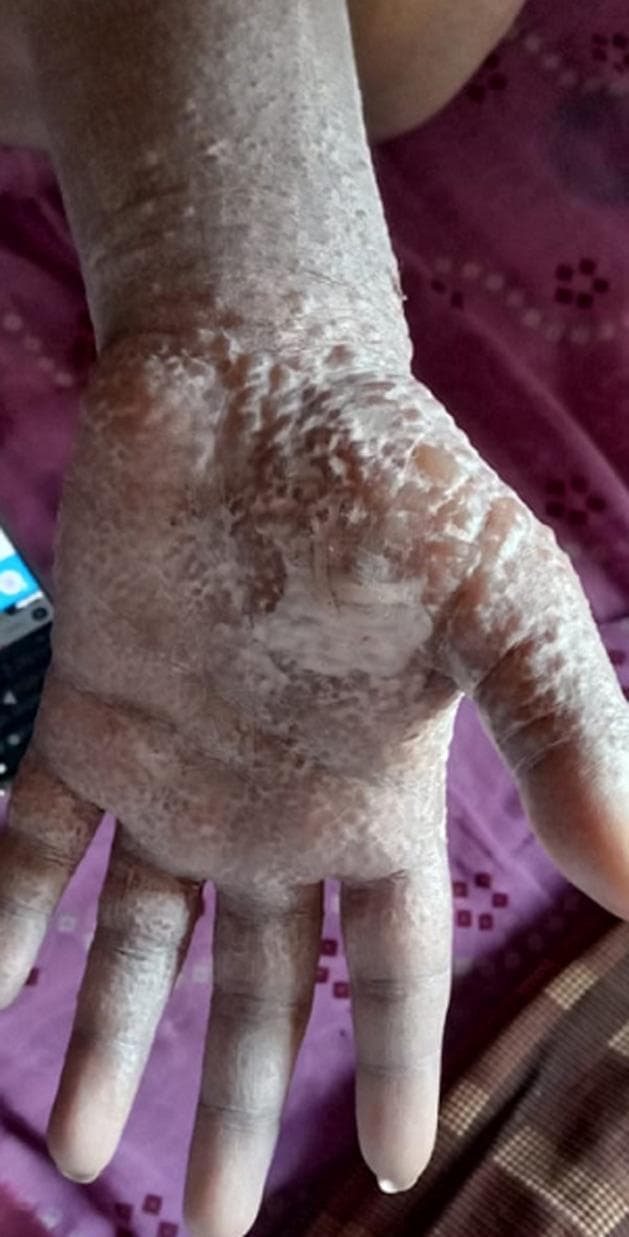 Clinical photograph of the palmar aspect of a human hand and wrist demonstrating a case of dyshidrotic eczema, also known as pompholyx. The image shows a dense, symmetric distribution of numerous small, deep-seated, ‘tapioca-like’ vesicles and bullae. These lesions are primarily concentrated on the palm and extend across the fingers and onto the volar wrist. The affected skin exhibits prominent morphological changes including whitish, translucent blisters, areas of scaling, and desquamation (skin peeling), which give the surface a rough, cobblestone-like texture. There is underlying mild erythema. The clinical presentation is characteristic of an acute pompholyx flare, often associated with severe pruritus (itching) or burning sensations, and serves as a classic educational example of vesicular hand dermatitis within the field of dermatology.